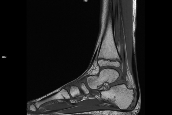 MRT von einem Fuß